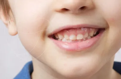 Çocuklarda Damak Yapısı Burun Nefesi Hakkında Ne Söyler?
