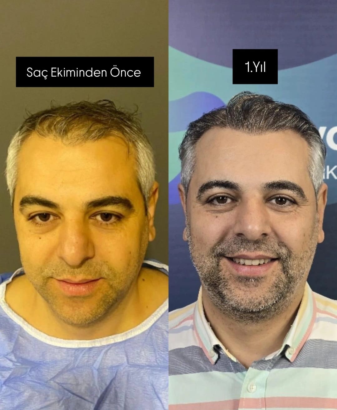 Saç ekimi öncesi ve 1 yıl sonrası - Hasta 2