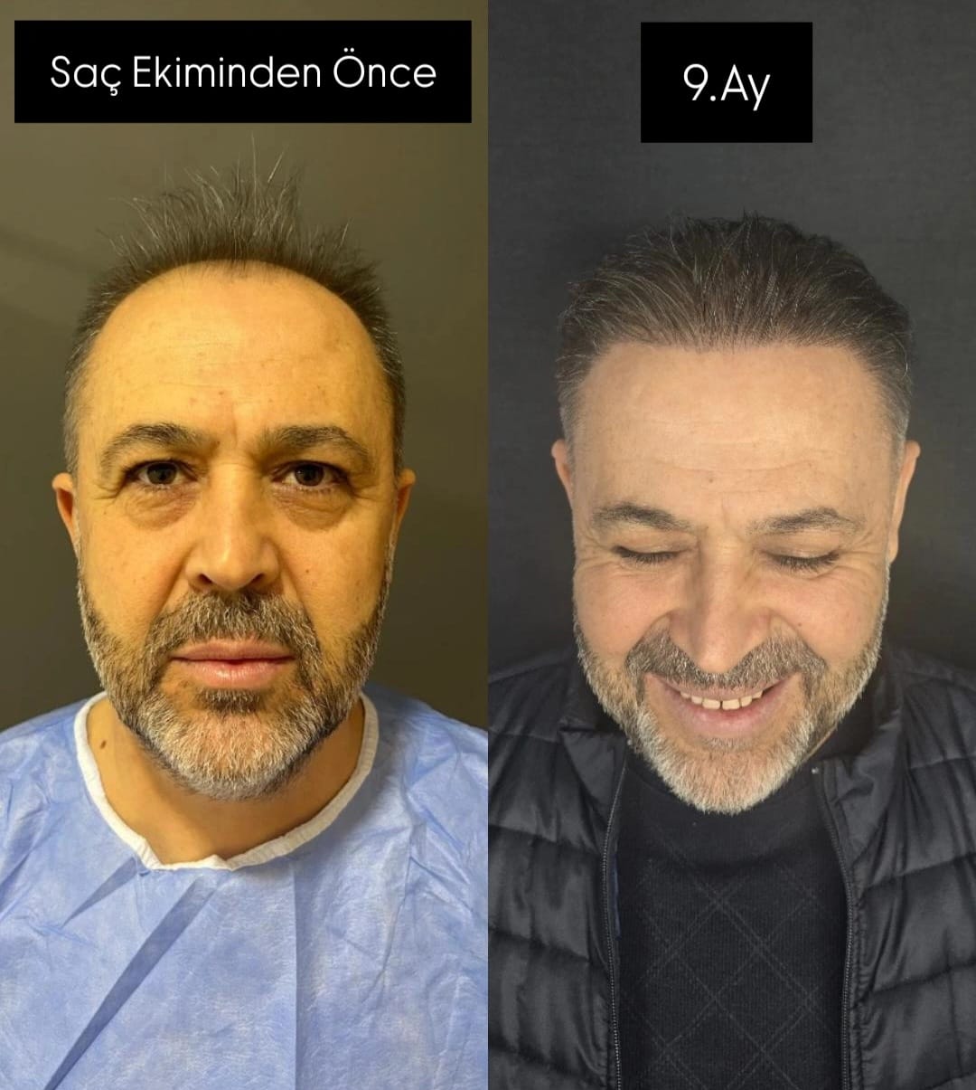 Saç ekimi öncesi ve 9. ay sonrası - Hasta 5